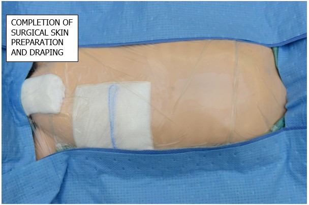 Faecal Stoma_surgical skin prep